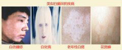 白斑和白癜风如何正确辨