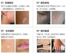 治疗身上白斑最快最有效