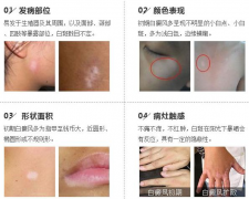 腿上长白点是什么病?怎