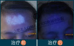 头部得了白癜风用什么方