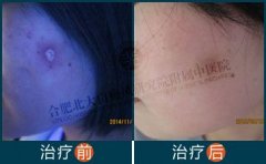 白癜风早期有哪些症状?如