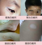 小孩脸部有白斑怎么办