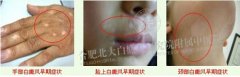 白癜风初期治疗最新方法