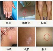 得了白癜风的主要危害是