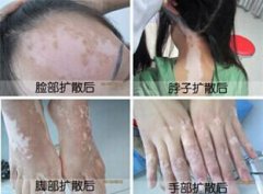 女性白癜风有哪些危害