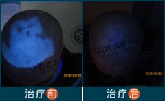  头部白癜风怎么治疗 