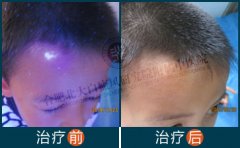 婴儿头部白癜风怎么治疗
