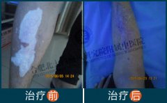 警惕!腿上出现白点是白