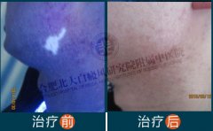男朋友身上白斑 我担心会