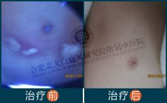  我的腰部白癜风康复历程 