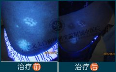  腰部有白癜风用什么方法 