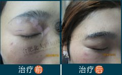 眼皮和隐私部位也能使用