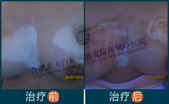 女性胸部长白癜风的原因