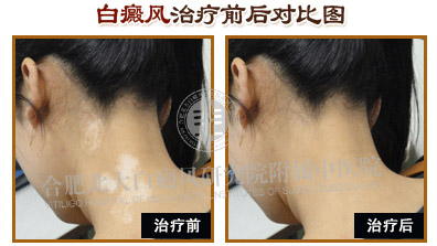 颈部长白斑是什么原因?怎