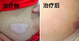 肚子开刀处有白斑的原因