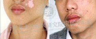 脸上长白斑是什么原因?怎