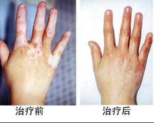 大拇指上长白斑是什么原