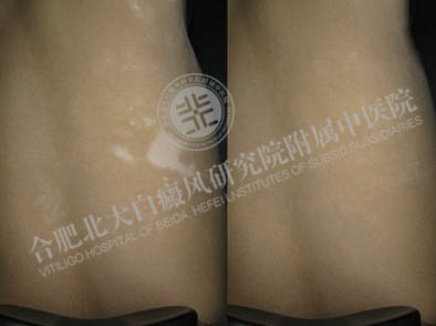 身上长白斑是什么原因?怎