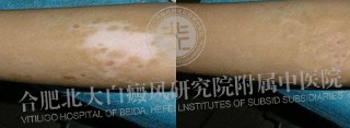 手臂上长白斑是什么原因