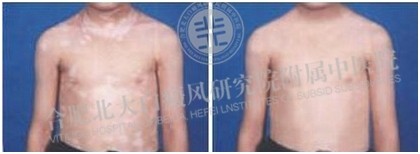 胸部长白斑是什么原因?怎