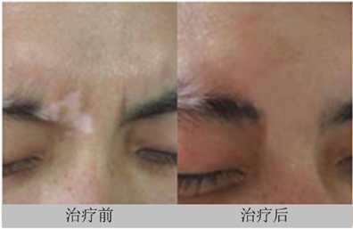 眼角长白斑是什么原因?怎