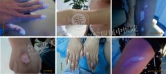 白癜风症状图集大全