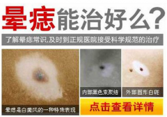 晕痣需要治疗吗?怎么治