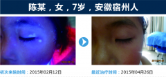  儿童白斑会是什么病？有 