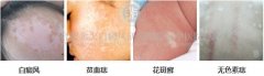  身上的白斑怎么治疗 