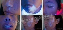 对比白斑图片,解析白癜