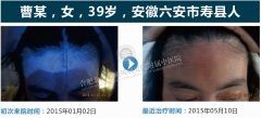 专家详解:女性白癜风症