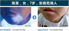 7岁女孩面部白斑 北大两月